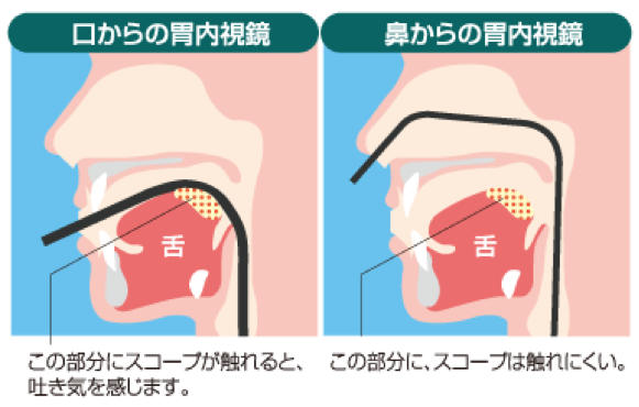 経鼻内視鏡で吐き気を軽減・図解