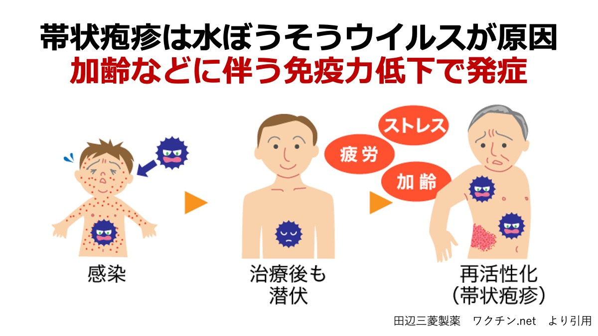 帯状疱疹と水痘の違いは何ですか?